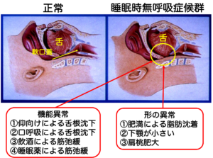 睡眠時無呼吸症候群の原因