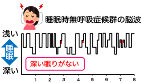 睡眠時無呼吸症候群の脳波