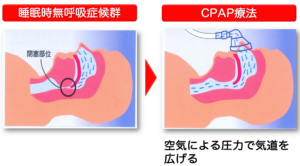 CPAP療法