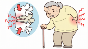 圧迫骨折した背骨のイラストと腰痛を訴える高齢女性のイラスト　神戸市灘区　六甲道　おおや内科　骨粗鬆症