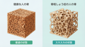 健康な人と骨粗鬆症の人の背骨の骨密度の比較をした図　神戸市灘区　六甲道　おおや内科　腰痛　膝の痛み