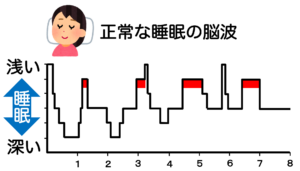 正常と睡眠時無呼吸症候群の脳波を比較
表