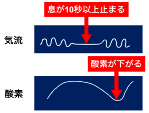 睡眠時無呼吸症候群（SAS:Sleep Apnea Syndrome）