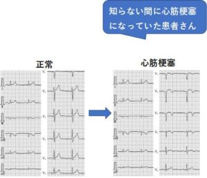 心電図の写真　糖尿病患者さんの心筋梗塞　神戸市灘区　六甲道　おおや内科　糖尿病・心臓クリニック