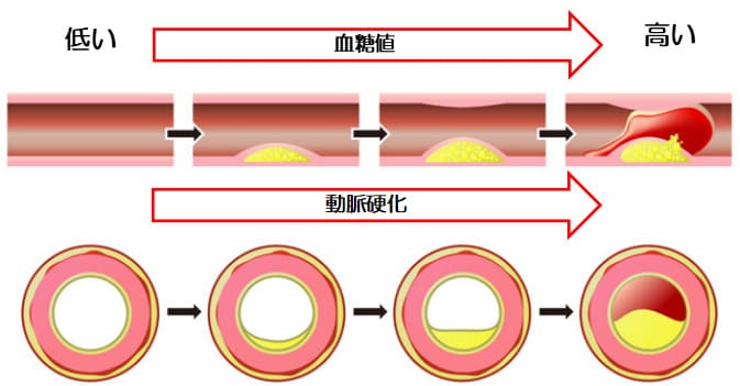 血糖値が高いとコレステロールが血管にたまりやすい