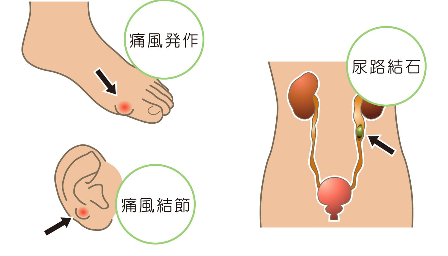 高尿酸血症（痛風）とは？