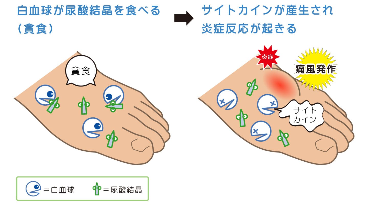 痛風発作を起こすメカニズムは？