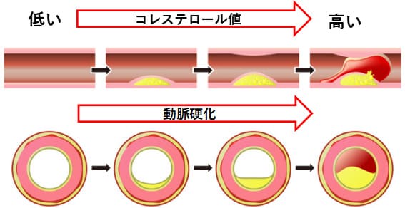 コレステロールが溜まって、血栓ができる