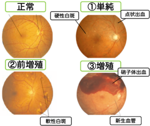 糖尿性網膜症の眼底写真