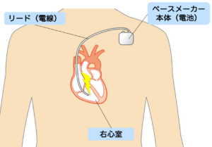 ペースメーカー植え込み術