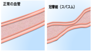 冠攣縮性狭心症