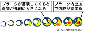 冠動脈にLDLコレステロールが蓄積する過程の図解