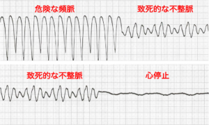 危険な頻脈、致命的な不整脈、心停止の図解