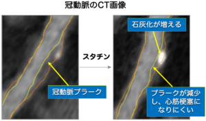 冠動脈CT画像