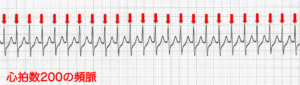 心拍数200の頻脈