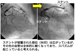 ステント留置後の冠攣縮に注意