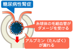 糖尿病はアルブミン尿に注意