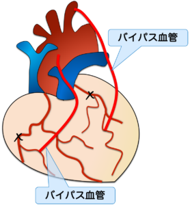 冠動脈バイパス術