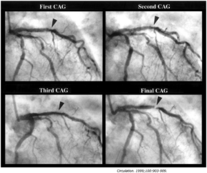 冠動脈造影