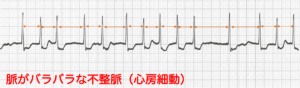 脈がバラバラな不整脈（心房細動）