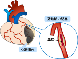 心臓の血管が閉塞し、心筋が壊死すること