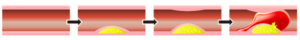 動脈硬化によるプラークの破綻