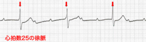 心拍数25の徐脈