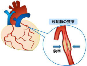 狭心症