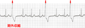 期外収縮