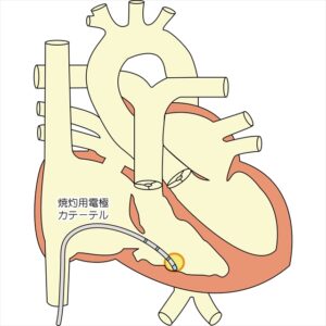 カテーテルアブレーション図解2