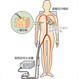 カテーテルアブレーション図解1