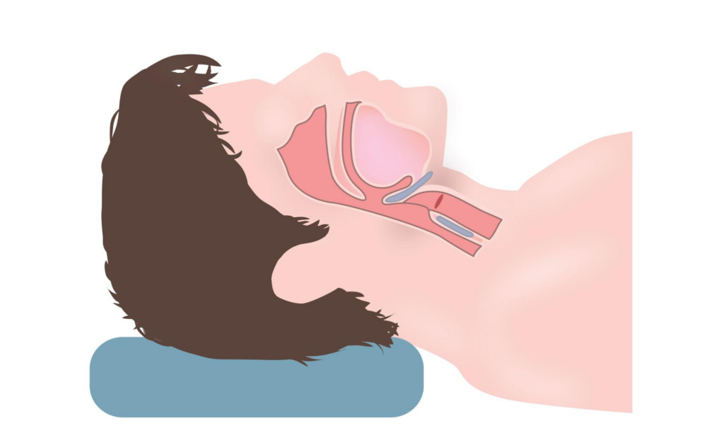 睡眠時無呼吸症候群と顔つきの関係とは